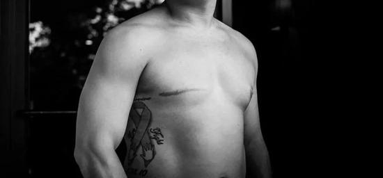  男性乳腺癌患者Bret Miller手术后。图片来源：Bret Miller |&nbsp;malebreastcancercoalition.org