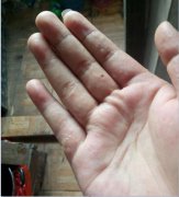 困扰将近一年的汗疱疹，终于治好了，跟大家一起分享我的经验