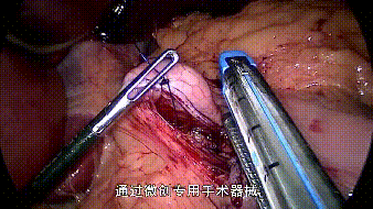 他们在大脑中植入芯片，只是为了减肥