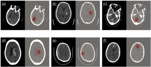 科亚医疗“CuraRad-ICH”获国内首个AI影像诊断系统FDA认证