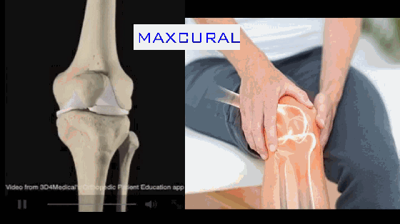 运动后膝盖痛，这么缓解很有效