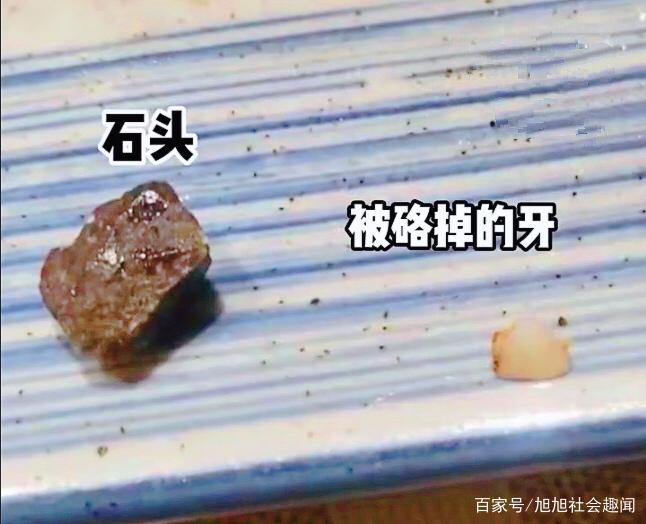男子饭店吃出石子被硌掉牙，河北某餐厅：给他免单，他还不愿意